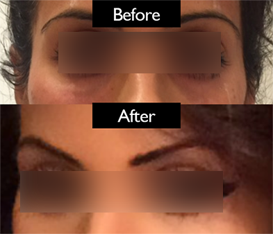brow-patient1